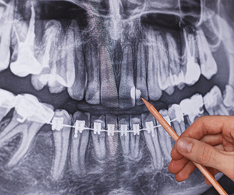 previadental-radiografia-panoramica-odontologica