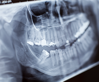 5-beneficios-de-la-tomografia-computarizada-dental-2