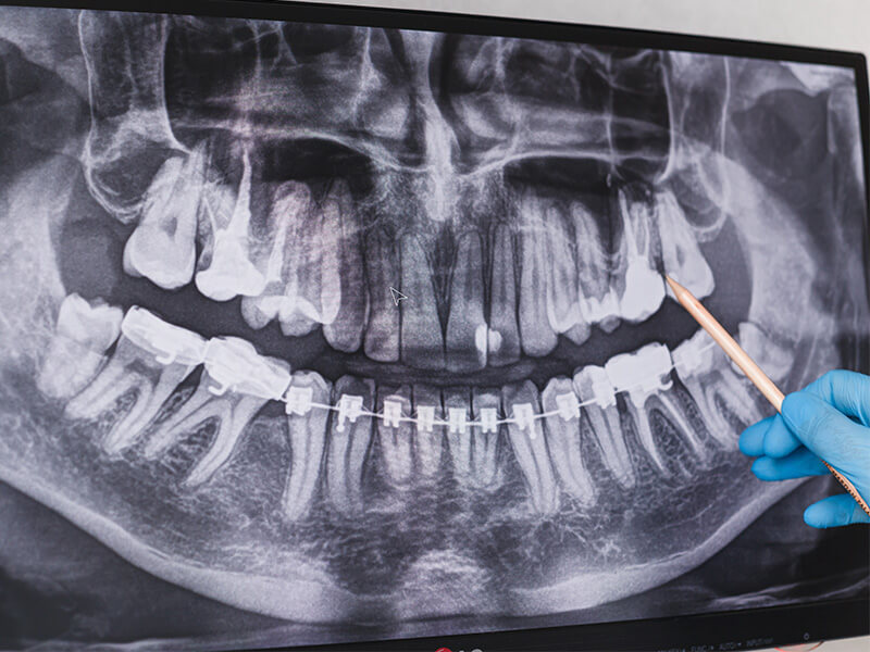 realmente-las-radiografias-dentales-son-peligrosas-a-previa-dental-works-tijuana